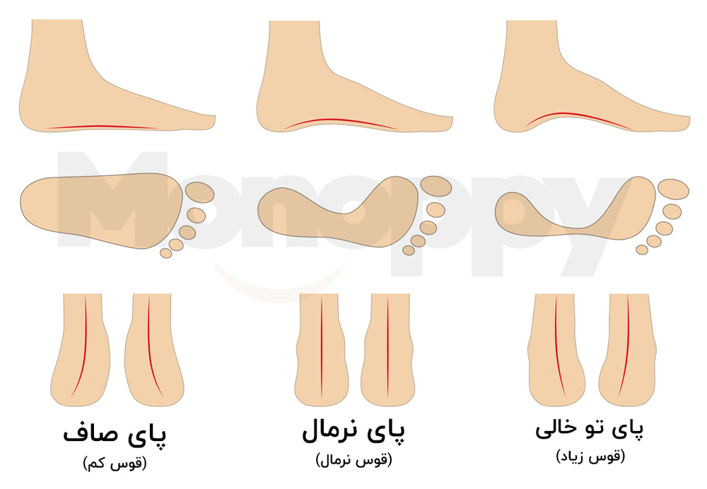 انواع پرونیشن مونوپی Monoppy