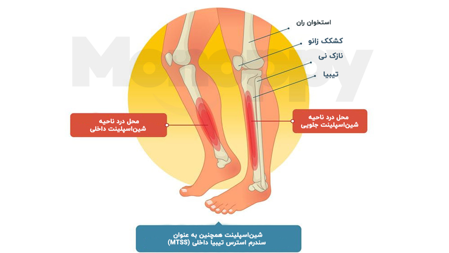 علائم سندرم استرس ساق پا یا شین اسپلینت